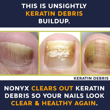 Fungal Nail Clarifying Gel | Clinically Proven for Discolored, Thick, Brittle, Yellow, Lifted, and Other Signs of Fungus-Damaged Toenails | 90% of Nails Improve | over 8 Million Sold