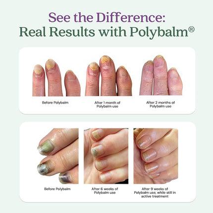 CLINICALLY PROVEN for Weak, Brittle Nails | All Natural Nail Repair Balm | Doctor Developed to Strengthen Nails Damaged by Chemotherapy, Gel or Nail Salon Manicures, Menopause & Aging | Made in the UK