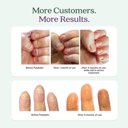 CLINICALLY PROVEN for Weak, Brittle Nails | All Natural Nail Repair Balm | Doctor Developed to Strengthen Nails Damaged by Chemotherapy, Gel or Nail Salon Manicures, Menopause & Aging | Made in the UK