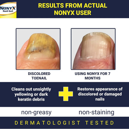Fungal Nail Clarifying Gel | Clinically Proven for Discolored, Thick, Brittle, Yellow, Lifted, and Other Signs of Fungus-Damaged Toenails | 90% of Nails Improve | over 8 Million Sold