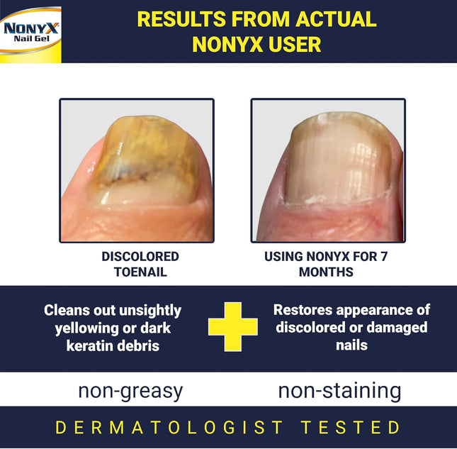 Fungal Nail Clarifying Gel | Clinically Proven for Discolored, Thick, Brittle, Yellow, Lifted, and Other Signs of Fungus-Damaged Toenails | 90% of Nails Improve | over 8 Million Sold