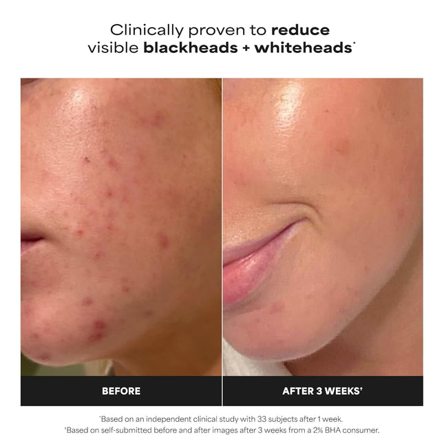 Paula’s Choice Skin Perfecting 2% BHA Liquid Exfoliant – Salicylic Acid Face Exfoliator for Clogged Pores, Blackheads & Fine Lines, Fragrance-Free Facial Treatment