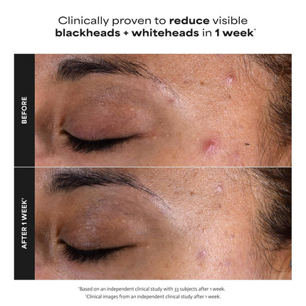 Paula’s Choice Skin Perfecting 2% BHA Liquid Exfoliant – Salicylic Acid Face Exfoliator for Clogged Pores, Blackheads & Fine Lines, Fragrance-Free Facial Treatment