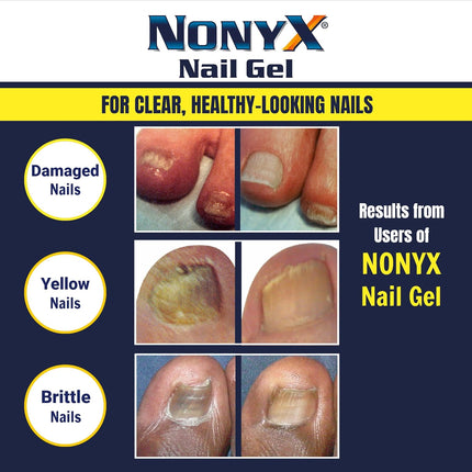 Fungal Nail Clarifying Gel | Clinically Proven for Discolored, Thick, Brittle, Yellow, Lifted, and Other Signs of Fungus-Damaged Toenails | 90% of Nails Improve | over 8 Million Sold